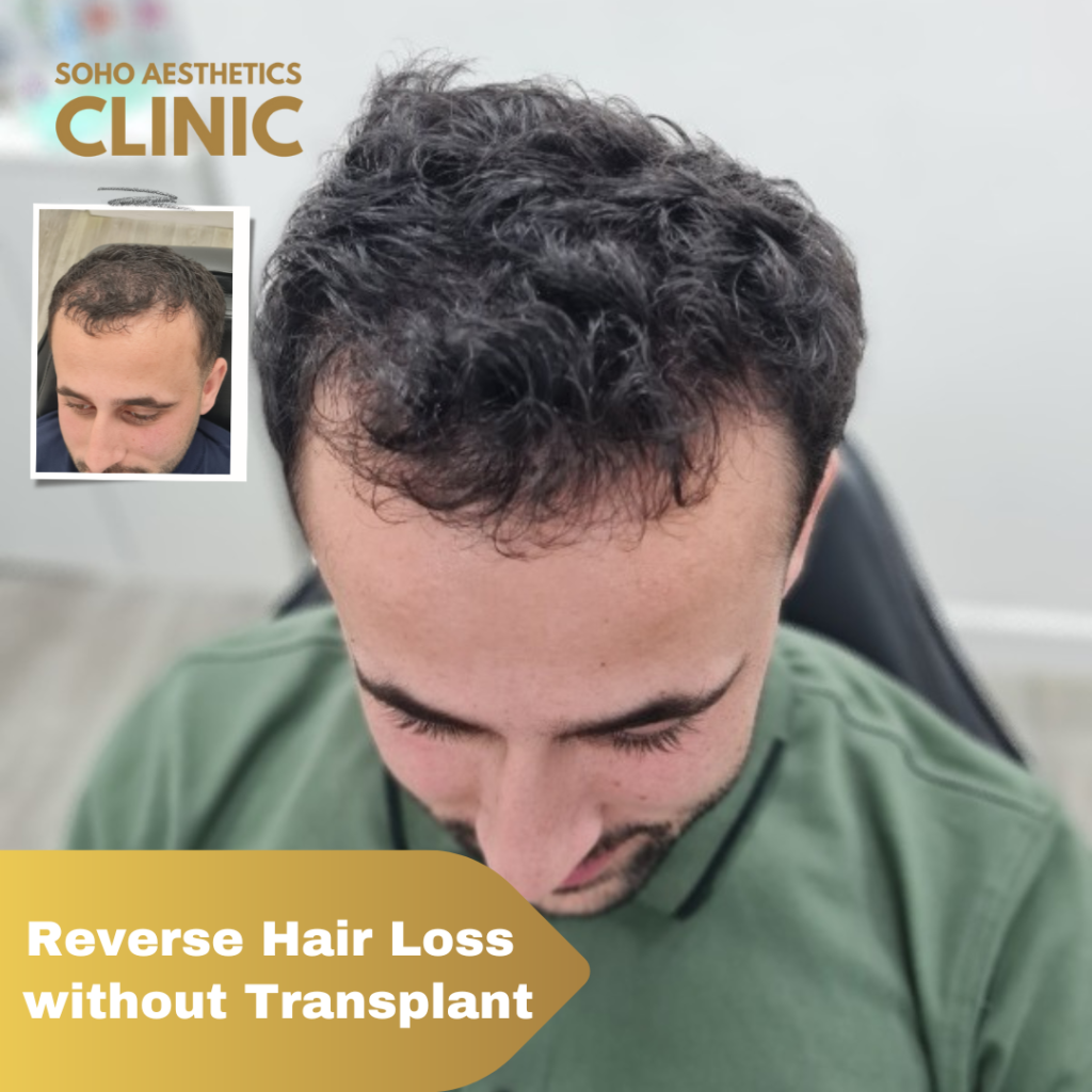 Male  Norwood 3 15  Canadian Hair Transplant Centre
