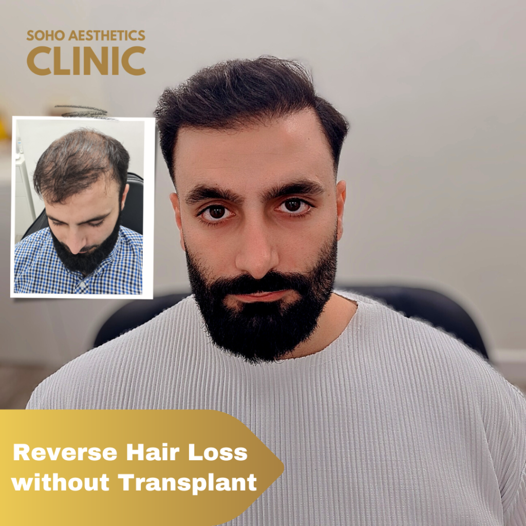 Result of PRP Therapy in Hair loss After 3 Months of Treatment